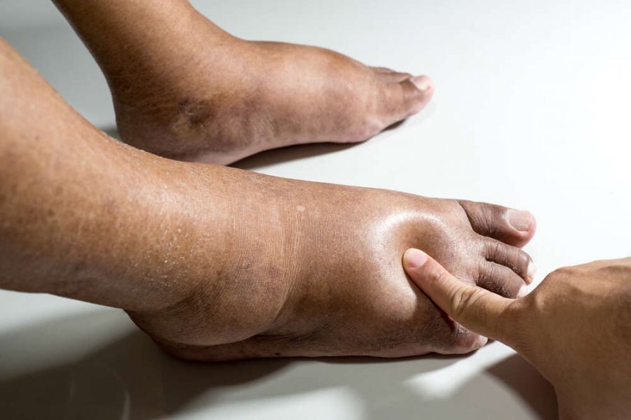 Уролог Джереми Оутс: Опухшие ноги могут указывать на рак мочевого пузыря